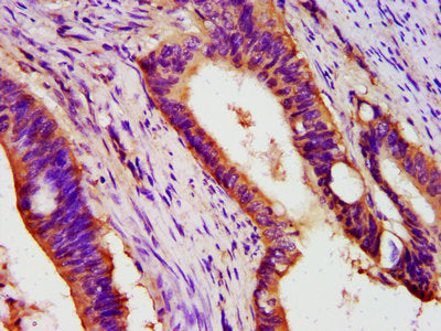 IHC image of PEX26 Antibody diluted at 1:400 and staining in paraffin-embedded human colon cancer performed on a Leica BondTM system. After dewaxing and hydration, antigen retrieval was mediated by high pressure in a citrate buffer (pH 6.0). Section was blocked with 10% normal goat serum 30min at RT. Then primary antibody (1% BSA) was incubated at 4°C overnight. The primary is detected by a biotinylated secondary antibody and visualized using an HRP conjugated SP system.Rabbit anti-Human PEX26 Polyclonal Antibody