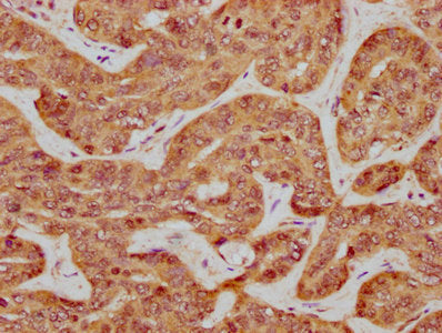 IHC image of ILDR1 Antibody diluted at 1:600 and staining in paraffin-embedded human liver cancer performed on a Leica BondTM system. After dewaxing and hydration, antigen retrieval was mediated by high pressure in a citrate buffer (pH 6.0). Section was blocked with 10% normal goat serum 30min at RT. Then primary antibody (1% BSA) was incubated at 4°C overnight. The primary is detected by a biotinylated secondary antibody and visualized using an HRP conjugated SP system.Rabbit anti-Human ILDR1 Polyclonal Antibody