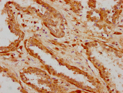 IHC image of ILDR1 Antibody diluted at 1:600 and staining in paraffin-embedded human prostate cancer performed on a Leica BondTM system. After dewaxing and hydration, antigen retrieval was mediated by high pressure in a citrate buffer (pH 6.0). Section was blocked with 10% normal goat serum 30min at RT. Then primary antibody (1% BSA) was incubated at 4°C overnight. The primary is detected by a biotinylated secondary antibody and visualized using an HRP conjugated SP system.Rabbit anti-Human ILDR1 Polyclonal Antibody