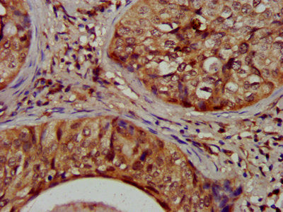 IHC image of NIT1 Antibody diluted at 1:1200 and staining in paraffin-embedded human cervical cancer performed on a Leica BondTM system. After dewaxing and hydration, antigen retrieval was mediated by high pressure in a citrate buffer (pH 6.0). Section was blocked with 10% normal goat serum 30min at RT. Then primary antibody (1% BSA) was incubated at 4°C overnight. The primary is detected by a biotinylated secondary antibody and visualized using an HRP conjugated SP system.Rabbit anti-Human NIT1 Polyclonal Antibody