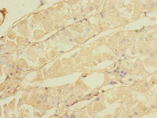 Immunohistochemistry of paraffin-embedded human gastric cancer using CALHM3 Antibody at dilution of 1:100