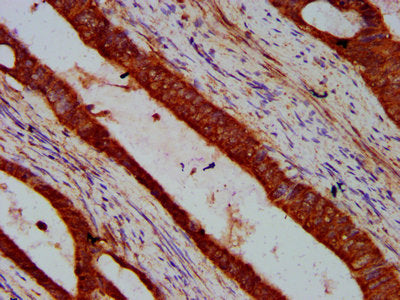 IHC image of the antibody diluted at 1:600 and staining in paraffin-embedded human colon cancer performed on a Leica BondTM system. After dewaxing and hydration, antigen retrieval was mediated by high pressure in a citrate buffer (pH 6.0). Section was blocked with 10% normal goat serum 30min at RT. Then primary antibody (1% BSA) was incubated at 4°C overnight. The primary is detected by a biotinylated secondary antibody and visualized using an HRP conjugated SP system.Rabbit anti-Human VRK2 Polyclonal Antibody