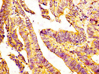 IHC image of GDF7 Antibody diluted at 1:300 and staining in paraffin-embedded human colon cancer performed on a Leica BondTM system. After dewaxing and hydration, antigen retrieval was mediated by high pressure in a citrate buffer (pH 6.0). Section was blocked with 10% normal goat serum 30min at RT. Then primary antibody (1% BSA) was incubated at 4°C overnight. The primary is detected by a biotinylated secondary antibody and visualized using an HRP conjugated SP system.Rabbit anti-Human GDF7 Polyclonal Antibody