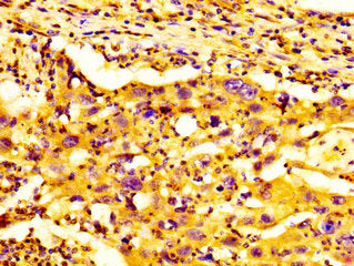 IHC image of GDF7 Antibody diluted at 1:300 and staining in paraffin-embedded human lung cancer performed on a Leica BondTM system. After dewaxing and hydration, antigen retrieval was mediated by high pressure in a citrate buffer (pH 6.0). Section was blocked with 10% normal goat serum 30min at RT. Then primary antibody (1% BSA) was incubated at 4°C overnight. The primary is detected by a biotinylated secondary antibody and visualized using an HRP conjugated SP system.Rabbit anti-Human GDF7 Polyclonal Antibody