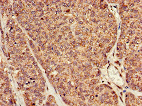 Immunohistochemistry of paraffin-embedded human ovarian cancer using RAI1 Antibody at dilution of 1:100Rabbit anti-Human RAI1 Polyclonal Antibody