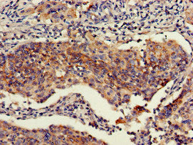 Immunohistochemistry of paraffin-embedded human cervical cancer using RBBP6 Antibody at dilution of 1:100