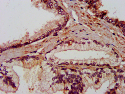IHC image of AMIGO2 Antibody diluted at 1:800 and staining in paraffin-embedded human prostate cancer performed on a Leica BondTM system. After dewaxing and hydration, antigen retrieval was mediated by high pressure in a citrate buffer (pH 6.0). Section was blocked with 10% normal goat serum 30min at RT. Then primary antibody (1% BSA) was incubated at 4°C overnight. The primary is detected by a biotinylated secondary antibody and visualized using an HRP conjugated SP system.Rabbit anti-Human AMIGO2 Polyclonal Antibody