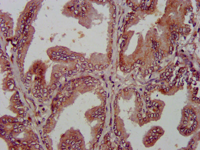 IHC image of AMIGO2 Antibody diluted at 1:800 and staining in paraffin-embedded human prostate tissue performed on a Leica BondTM system. After dewaxing and hydration, antigen retrieval was mediated by high pressure in a citrate buffer (pH 6.0). Section was blocked with 10% normal goat serum 30min at RT. Then primary antibody (1% BSA) was incubated at 4°C overnight. The primary is detected by a biotinylated secondary antibody and visualized using an HRP conjugated SP system.Rabbit anti-Human AMIGO2 Polyclonal Antibody