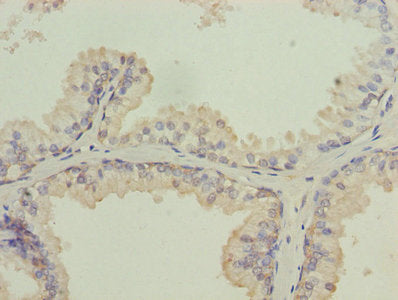 Immunohistochemistry of paraffin-embedded human prostate cancer using ISCA2 Antibody at dilution of 1:100