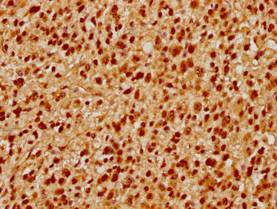IHC image of the antibody diluted at 1:500 and staining in paraffin-embedded human glioma performed on a Leica BondTM system. After dewaxing and hydration, antigen retrieval was mediated by high pressure in a citrate buffer (pH 6.0). Section was blocked with 10% normal goat serum 30min at RT. Then primary antibody (1% BSA) was incubated at 4°C overnight. The primary is detected by a biotinylated secondary antibody and visualized using an HRP conjugated SP system.Rabbit anti-Human PRPF39 Polyclonal Antibody