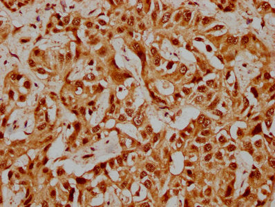 IHC image of PRPF39 Antibody diluted at 1:500 and staining in paraffin-embedded human liver cancer performed on a Leica BondTM system. After dewaxing and hydration, antigen retrieval was mediated by high pressure in a citrate buffer (pH 6.0). Section was blocked with 10% normal goat serum 30min at RT. Then primary antibody (1% BSA) was incubated at 4°C overnight. The primary is detected by a biotinylated secondary antibody and visualized using an HRP conjugated SP system.Rabbit anti-Human PRPF39 Polyclonal Antibody
