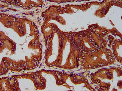 IHC image of the antibody diluted at 1:200 and staining in paraffin-embedded human prostate tissue performed on a Leica BondTM system. After dewaxing and hydration, antigen retrieval was mediated by high pressure in a citrate buffer (pH 6.0). Section was blocked with 10% normal goat serum 30min at RT. Then primary antibody (1% BSA) was incubated at 4°C overnight. The primary is detected by a biotinylated secondary antibody and visualized using an HRP conjugated SP system.Rabbit anti-Human EVC2 Polyclonal Antibody