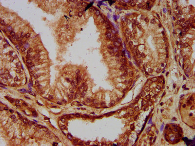 IHC image of EVC2 Antibody diluted at 1:200 and staining in paraffin-embedded human prostate cancer performed on a Leica BondTM system. After dewaxing and hydration, antigen retrieval was mediated by high pressure in a citrate buffer (pH 6.0). Section was blocked with 10% normal goat serum 30min at RT. Then primary antibody (1% BSA) was incubated at 4°C overnight. The primary is detected by a biotinylated secondary antibody and visualized using an HRP conjugated SP system.Rabbit anti-Human EVC2 Polyclonal Antibody