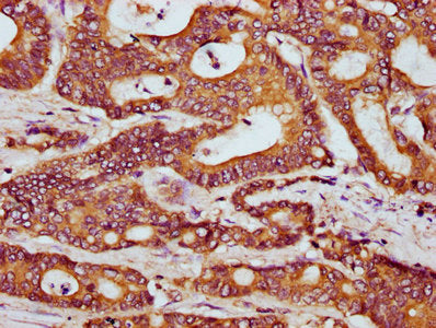 IHC image of HOOK3 Antibody diluted at 1:300 and staining in paraffin-embedded human colon cancer performed on a Leica BondTM system. After dewaxing and hydration, antigen retrieval was mediated by high pressure in a citrate buffer (pH 6.0). Section was blocked with 10% normal goat serum 30min at RT. Then primary antibody (1% BSA) was incubated at 4°C overnight. The primary is detected by a biotinylated secondary antibody and visualized using an HRP conjugated SP system.Rabbit anti-Human HOOK3 Polyclonal Antibody