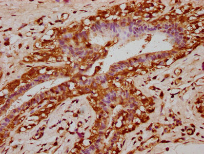IHC image of KLB Antibody diluted at 1:200 and staining in paraffin-embedded human breast cancer performed on a Leica BondTM system. After dewaxing and hydration, antigen retrieval was mediated by high pressure in a citrate buffer (pH 6.0). Section was blocked with 10% normal goat serum 30min at RT. Then primary antibody (1% BSA) was incubated at 4°C overnight. The primary is detected by a biotinylated secondary antibody and visualized using an HRP conjugated SP system.