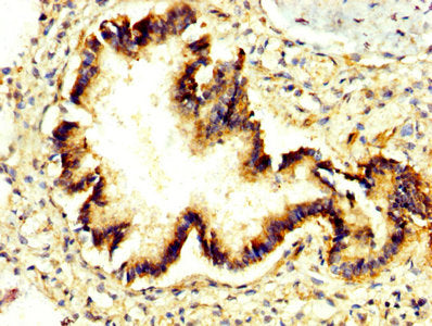 IHC image of PRUNE1 Antibody diluted at 1:300 and staining in paraffin-embedded human lung tissue performed on a Leica BondTM system. After dewaxing and hydration, antigen retrieval was mediated by high pressure in a citrate buffer (pH 6.0). Section was blocked with 10% normal goat serum 30min at RT. Then primary antibody (1% BSA) was incubated at 4°C overnight. The primary is detected by a biotinylated secondary antibody and visualized using an HRP conjugated SP system.Rabbit anti-Human PRUNE1 Polyclonal Antibody