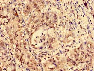 Immunohistochemistry of paraffin-embedded human liver cancer using LDB1 Antibody at dilution of 1:100