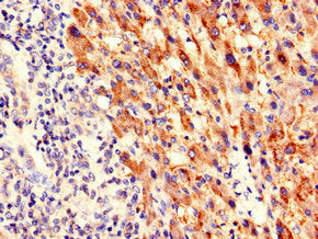 Immunohistochemistry of paraffin-embedded human liver cancer using PIM3 Antibody at dilution of 1:100Rabbit anti-Human PIM3 Polyclonal Antibody