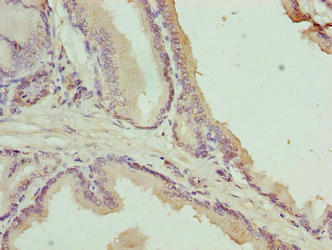 Immunohistochemistry of paraffin-embedded human prostate cancer using C17orf64 Antibody at dilution of 1:100