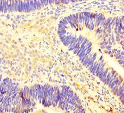 Immunohistochemistry of paraffin-embedded human ovarian cancer using CARM1 Antibody at dilution of 1:100
