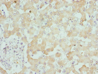Immunohistochemistry of paraffin-embedded human liver tissue using DCXR Antibody at dilution of 1:100Rabbit anti-Human DCXR Polyclonal Antibody