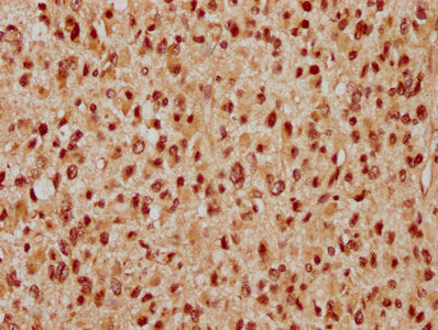 IHC image of the antibody diluted at 1:300 and staining in paraffin-embedded human glioma performed on a Leica BondTM system. After dewaxing and hydration, antigen retrieval was mediated by high pressure in a citrate buffer (pH 6.0). Section was blocked with 10% normal goat serum 30min at RT. Then primary antibody (1% BSA) was incubated at 4°C overnight. The primary is detected by a biotinylated secondary antibody and visualized using an HRP conjugated SP system.Rabbit anti-Human WAPL Polyclonal Antibody