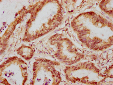 IHC image of WAPL Antibody diluted at 1:300 and staining in paraffin-embedded human colon cancer performed on a Leica BondTM system. After dewaxing and hydration, antigen retrieval was mediated by high pressure in a citrate buffer (pH 6.0). Section was blocked with 10% normal goat serum 30min at RT. Then primary antibody (1% BSA) was incubated at 4°C overnight. The primary is detected by a biotinylated secondary antibody and visualized using an HRP conjugated SP system.Rabbit anti-Human WAPL Polyclonal Antibody