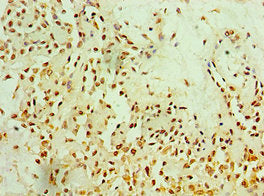 Immunohistochemistry of paraffin-embedded human breast cancer using the antibody at dilution of 1:100Rabbit anti-Human MTDH Polyclonal Antibody