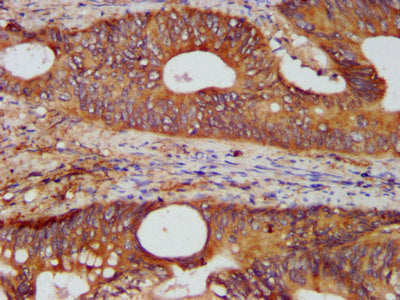 IHC image of KTN1 Antibody diluted at 1:400 and staining in paraffin-embedded human colon cancer performed on a Leica BondTM system. After dewaxing and hydration, antigen retrieval was mediated by high pressure in a citrate buffer (pH 6.0). Section was blocked with 10% normal goat serum 30min at RT. Then primary antibody (1% BSA) was incubated at 4°C overnight. The primary is detected by a biotinylated secondary antibody and visualized using an HRP conjugated SP system.