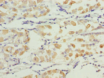 Immunohistochemistry of paraffin-embedded human gastric cancer using the antibody at dilution of 1:100Rabbit anti-Human SMG6 Polyclonal Antibody