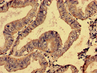 Immunohistochemistry analysis of human endometrial cancer using SMG6 Antibody at dilution of 1:100Rabbit anti-Human SMG6 Polyclonal Antibody