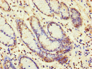 Immunohistochemistry of paraffin-embedded human gastric cancer using SBF2 Antibody at dilution of 1:100Rabbit anti-Human SBF2 Polyclonal Antibody