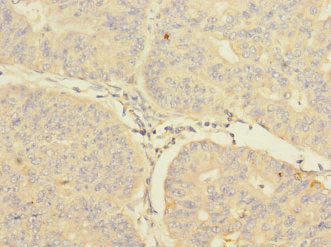 Immunohistochemistry of paraffin-embedded human endometrial cancer using CIR1 Antibody at dilution of 1:100Rabbit anti-Human CIR1 Polyclonal Antibody
