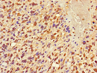 Immunohistochemistry of paraffin-embedded human glioma using FRMD5 Antibody at dilution of 1:100Rabbit anti-Human FRMD5 Polyclonal Antibody
