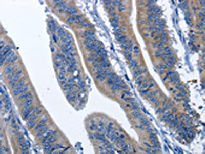 The image on the left is immunohistochemistry of paraffin-embedded Human colon cancer tissue using CDK5RAP3 Antibody(CDK5RAP3 Antibody) at dilution 1/60, on the right is treated with fusion protein. (Original magnification: ×200)Rabbit anti-Human CDK5RAP3 Polyclonal Antibody
