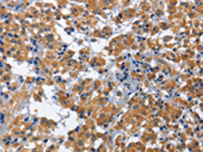 The image on the left is immunohistochemistry of paraffin-embedded Human thyroid cancer tissue using the antibody Antibody) at dilution 1/60, on the right is treated with fusion protein. (Original magnification: ×200)Rabbit anti-Human CDK5RAP3 Polyclonal Antibody