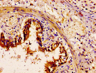 IHC image of the antibody diluted at 1:100 and staining in paraffin-embedded human lung tissue performed on a Leica BondTM system. After dewaxing and hydration, antigen retrieval was mediated by high pressure in a citrate buffer (pH 6.0). Section was blocked with 10% normal goat serum 30min at RT. Then primary antibody (1% BSA) was incubated at 4°C overnight. The primary is detected by a biotinylated secondary antibody and visualized using an HRP conjugated SP system.Rabbit anti-Human MYH14 Polyclonal Antibody