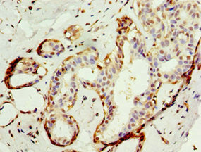 Immunohistochemistry of paraffin-embedded human breast cancer using APBB1IP Antibody at dilution of 1:100Rabbit anti-Human APBB1IP Polyclonal Antibody