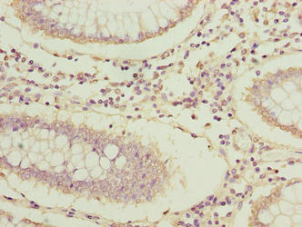 Immunohistochemistry of paraffin-embedded human colon cancer using ARPIN Antibody at dilution of 1:100Rabbit anti-Human ARPIN Polyclonal Antibody