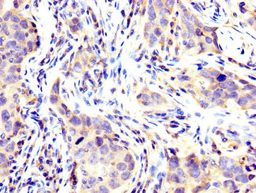 IHC image of USP48 Antibody diluted at 1:200 and staining in paraffin-embedded human pancreatic cancer performed on a Leica BondTM system. After dewaxing and hydration, antigen retrieval was mediated by high pressure in a citrate buffer (pH 6.0). Section was blocked with 10% normal goat serum 30min at RT. Then primary antibody (1% BSA) was incubated at 4°C overnight. The primary is detected by a biotinylated secondary antibody and visualized using an HRP conjugated SP system.
