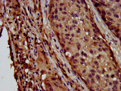 IHC image of LAPTM4B Antibody diluted at 1:600 and staining in paraffin-embedded human lung cancer performed on a Leica BondTM system. After dewaxing and hydration, antigen retrieval was mediated by high pressure in a citrate buffer (pH 6.0). Section was blocked with 10% normal goat serum 30min at RT. Then primary antibody (1% BSA) was incubated at 4°C overnight. The primary is detected by a biotinylated secondary antibody and visualized using an HRP conjugated SP system.