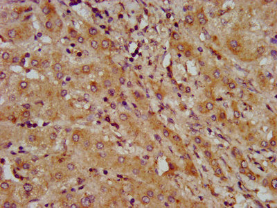 IHC image of LAPTM4B Antibody diluted at 1:600 and staining in paraffin-embedded human liver cancer performed on a Leica BondTM system. After dewaxing and hydration, antigen retrieval was mediated by high pressure in a citrate buffer (pH 6.0). Section was blocked with 10% normal goat serum 30min at RT. Then primary antibody (1% BSA) was incubated at 4°C overnight. The primary is detected by a biotinylated secondary antibody and visualized using an HRP conjugated SP system.