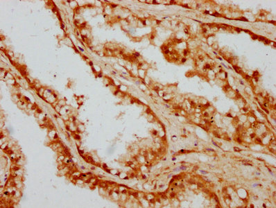 IHC image of CAND1 Antibody diluted at 1:300 and staining in paraffin-embedded human prostate cancer performed on a Leica BondTM system. After dewaxing and hydration, antigen retrieval was mediated by high pressure in a citrate buffer (pH 6.0). Section was blocked with 10% normal goat serum 30min at RT. Then primary antibody (1% BSA) was incubated at 4°C overnight. The primary is detected by a biotinylated secondary antibody and visualized using an HRP conjugated SP system.
