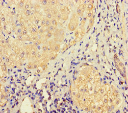 Immunohistochemistry of paraffin-embedded human liver cancer using LHFPL1 Antibody at dilution of 1:100