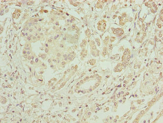 Immunohistochemistry of paraffin-embedded human pancreatic cancer using ERO1B Antibody at dilution of 1:100Rabbit anti-Human ERO1B Polyclonal Antibody