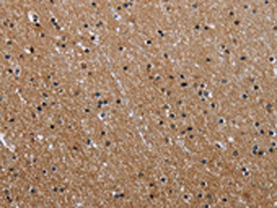 The image on the left is immunohistochemistry of paraffin-embedded Human brain  tissue using GAB2 Antibody(GAB2 Antibody) at dilution 1/40, on the right is treated with fusion protein. (Original magnification: ×200)Rabbit anti-Human GAB2 Polyclonal Antibody