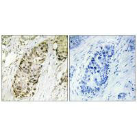 Immunohistochemistry analysis of paraffin-embedded human lung carcinoma tissue using GA45G antibody.Rabbit anti-Human GADD45G Polyclonal Antibody