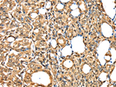 The image on the left is immunohistochemistry of paraffin-embedded Human thyroid cancer tissue using PSMB8 Antibody(PSMB8 Antibody) at dilution 1/30, on the right is treated with synthetic peptide. (Original magnification: ×200)Rabbit anti-Human PSMB8 Polyclonal Antibody