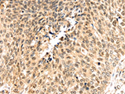 The image on the left is immunohistochemistry of paraffin-embedded Human lung cancer tissue using the antibody Antibody) at dilution 1/30, on the right is treated with synthetic peptide. (Original magnification: ×200)Rabbit anti-Human PSMB8 Polyclonal Antibody