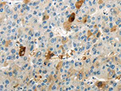 The image is immunohistochemistry of paraffin-embedded human liver cancer tissue using the antibody Antibody) at dilution 1/20. (Original magnification: ×200)Rabbit anti-Human WNK1 Polyclonal Antibody